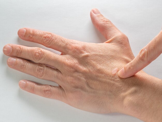 Close up of an old wart on a hand