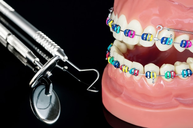 Foto primo piano modello ortodontico - modello dimostrativo di denti di varietà di attacchi ortodontici o tutori