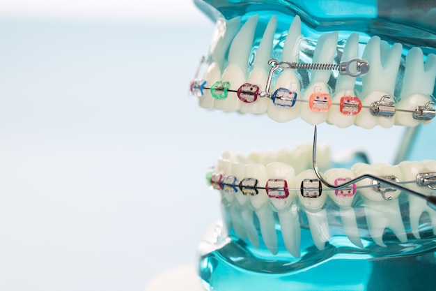 Close up orthodontic model 