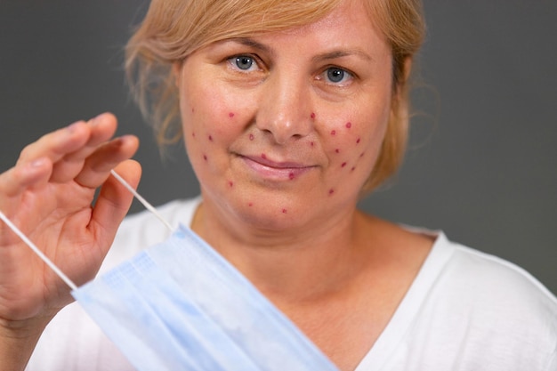 Close up photo of a pretty blonde woman with irritating red spots on her face she has acne problem a...