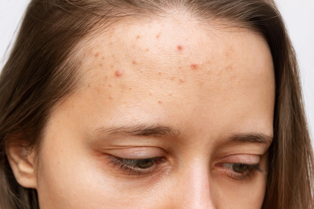 Close up of pimples on forehead cropped shot of young woman\'s\
face with acne problem problem skin