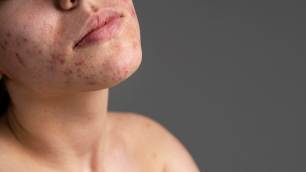 Foto ritratto del primo piano di giovane donna con l'acne