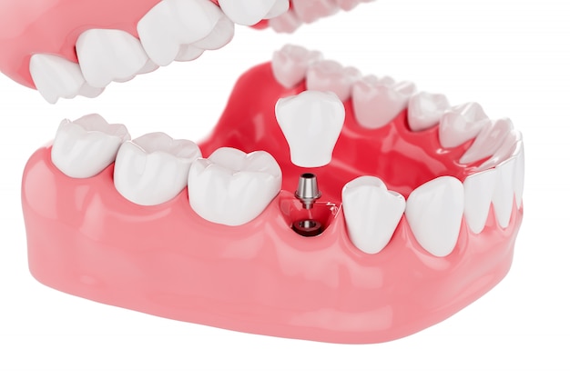 Close up Process Implants teeth health care. Selective focus. 3D Render.