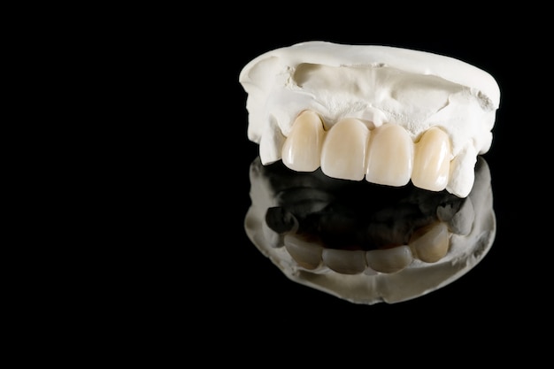 Close-up / prothetiek of prothese / tandkroon en brugimplantaat tandheelkundige apparatuur en model express fix restauratie.