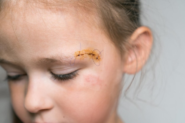 Photo close up sad brave drear cropped girl face with stitches on scratch of eyebrow dissection looking down medicine aid