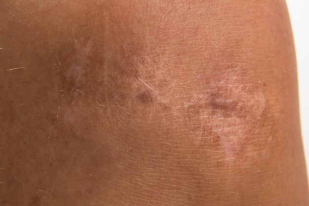 Close up scar on skin Healed scar