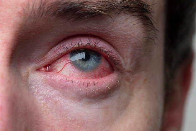 Close up of a severe bloodshot eye blepharitis conjunctivitis condition