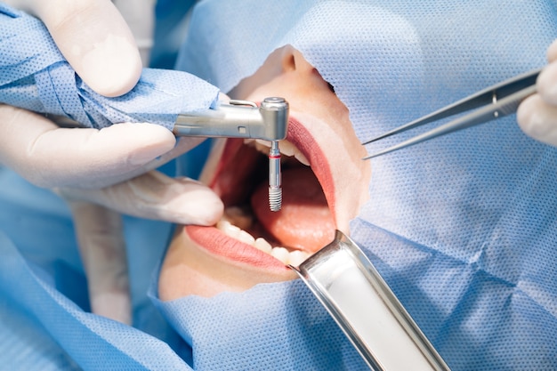 Close-up shot of attentive doctors performing surgical operation installing dental implants into patient's mouth in modern dental clinic.