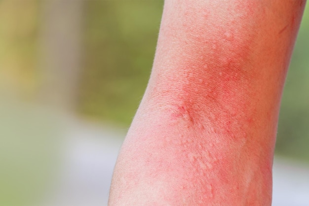 写真 腕の皮膚のかゆみをクローズアップ皮膚の体にアレルギーのある毛虫の刺傷や虫刺され皮膚炎ヘルスケアの概念