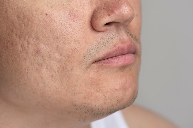 Close up on skin pores during face care routine