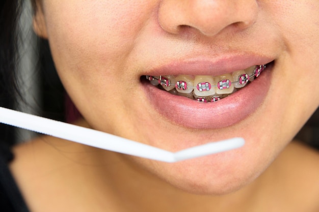 Foto close-up di una giovane donna sorridente che indossa un apparecchio ortodontico