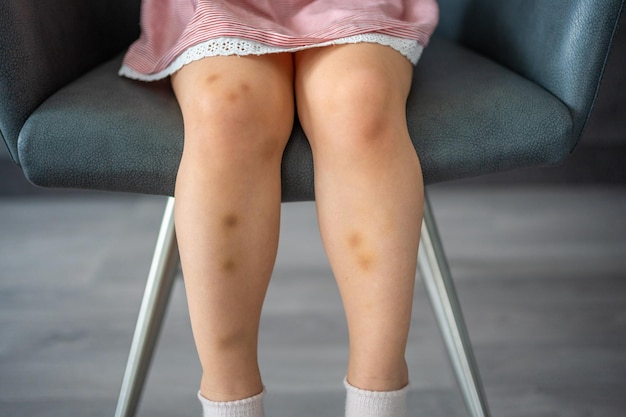 Close up of stains bruise wound on legs of little girl extravasation blue purple on skin active chil