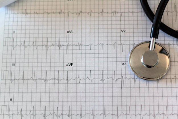 Photo close-up of stethoscope on pulse trace