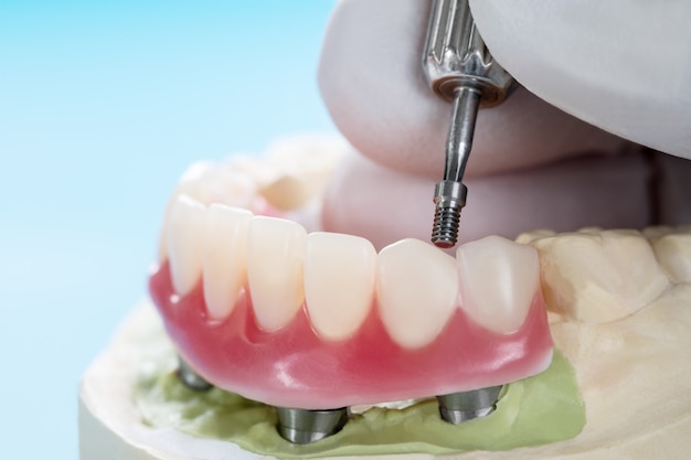 Close-up tandheelkundige implantaten ondersteund overdenture op blauw.