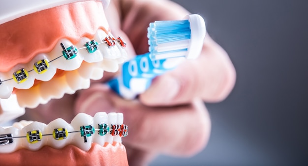 Close-up teeth braces and tooth brush as an example of toothbrushing.