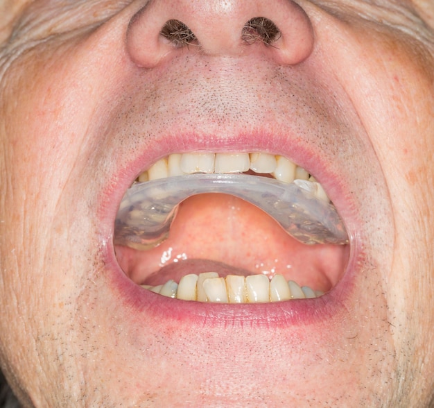 Photo close up of teeth guard in senior mouth