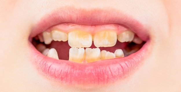 Close up of unhealthy baby teeths Kid patient open mouth showing cavities teeth decay Bad teeth child Portrait boy with bad teeth Child smile and show her crowding tooth