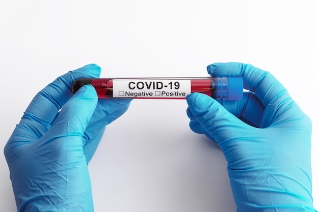 Close-up van de hand van de wetenschapper met een bloedmonster van COVID-19