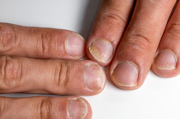 Close-up van de vingers van een patiënt met psoriatische onychodystrofie of psoriatische nagelziekte