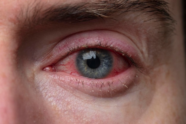 Foto close-up van een ernstige bloeddoorlopen oog blepharitis conjunctivitis aandoening