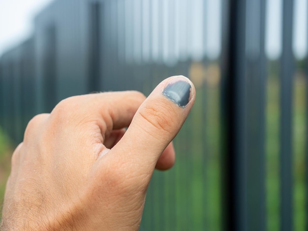 Close-up van een geslagen duim Onscherpe achtergrond Letsel op het werk blauwe plek hematoom Selectieve focus