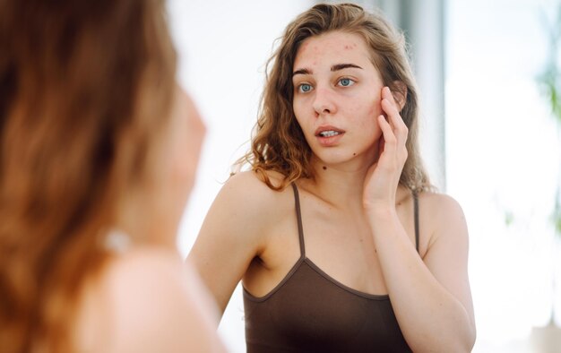 Close-up van een jonge vrouw die naar puistjes in de spiegel kijkt Rode vlekken uitslag acne huidbehandeling