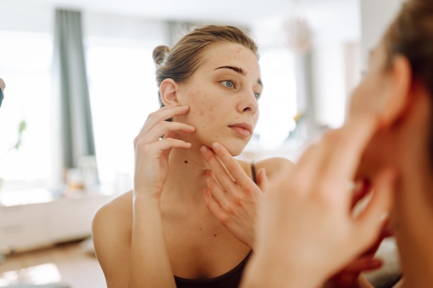 Close-up van een jonge vrouw die naar puistjes in de spiegel kijkt Rode vlekken uitslag acne huidbehandeling