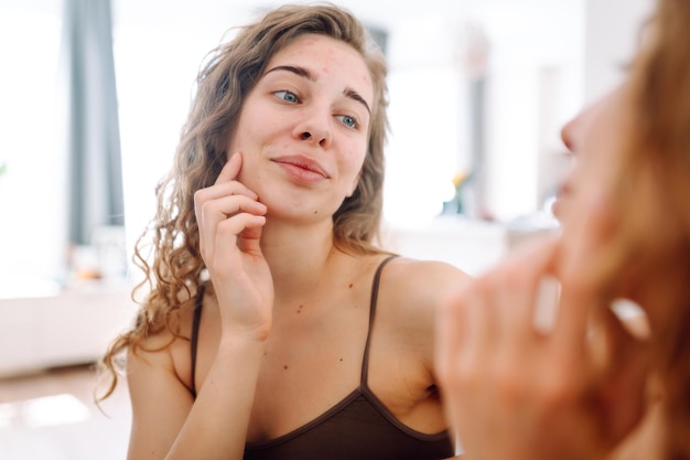 Close-up van een jonge vrouw die naar puistjes in de spiegel kijkt Rode vlekken uitslag acne huidbehandeling