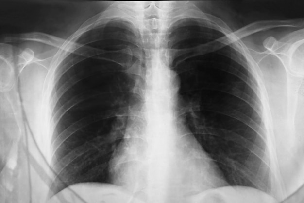Close-up van een röntgenfoto van de borst
