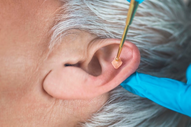 Foto close-up van een vrouw die auriculotherapie krijgt