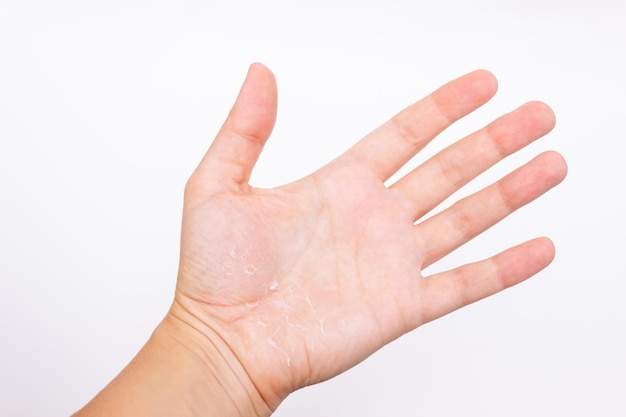 Close-up van een vrouwelijke hand met schilferende huid op een palm geïsoleerd op een witte achtergrond Allergieën eczeem