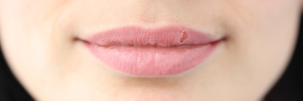 Close-up van herpeszweren op lippen van jonge vrouwenbehandeling en diagnose van dermatologisch