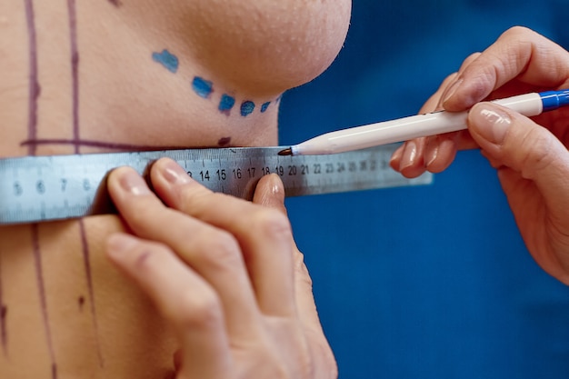 Close-up van het lichaam van de naakte vrouw met zwarte chirurgische tekens op haar borst. Artsenhanden die lijnen trekken op vrouwelijke borst vóór de operatie van de borstvergroting.