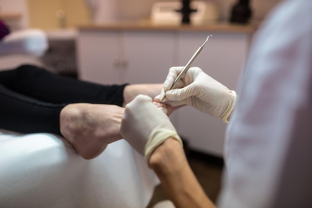 Close-up van het verwijderen van de nagelriem van teennagels in een pedicurebehandeling.