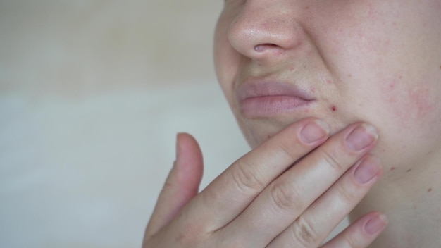 Close-up van huidproblemen ongezonde huid met acne en puistjes Poreuze demodex en rosacea rode huiduitslag Het concept van zorg voor een probleemhuid Allergisch en roodheid