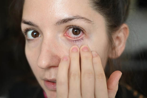 Close-up van jonge vrouw met rood ontstoken en verwijd haarvaten oog Allergie conjunctivitis ontsteking