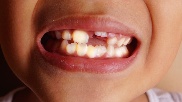 Foto close-up van jongen met gapende tanden