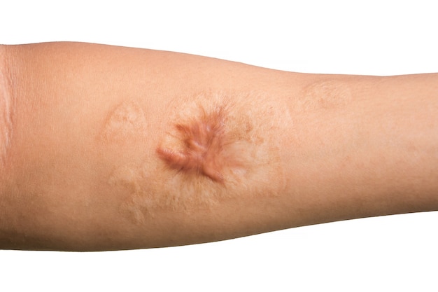 Foto close-up van keloïde litteken hypertrofisch litteken op de huid van de arm van de mens na ongeval op witte achtergrond