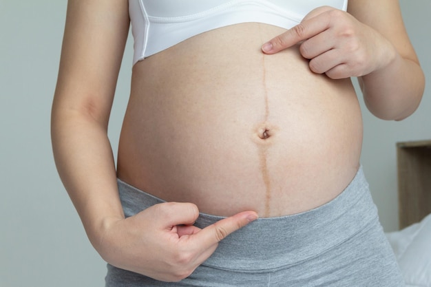 Close-up van linea nigra en striae bij zwangere vrouwen in het laatste trimester van de zwangerschap