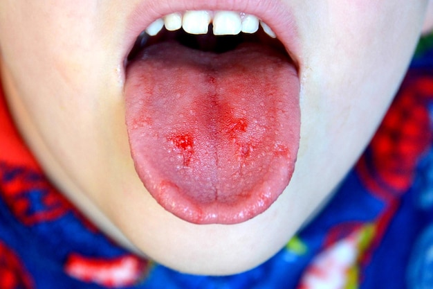 Foto close-up van lippen tong uitsteeksel van bloed kind gebeten tong