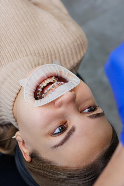 Close-up van mond en tanden met metalen beugels. Orthodontische tandheelkundige behandeling