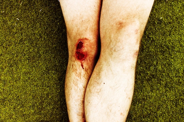 Foto close-up van persoon met gekneusde knie