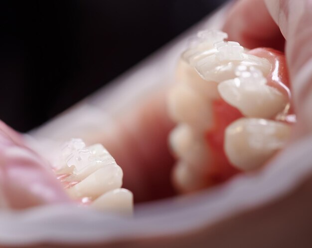 Close-up van persoon met open mond en witte tanden met orthodontische beugels Patiënt met wangretractor in de mond die een tandheelkundige ingreep ondergaat in de kliniek Concept van orthodontische behandeling