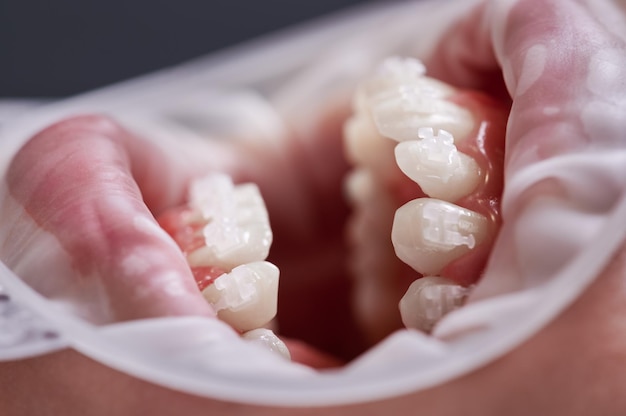 Close-up van persoon met open mond en witte tanden met orthodontische beugels Patiënt met wangretractor in de mond die tandheelkundige ingreep ondergaat in de kliniek Concept van tandheelkundige orthodontische behandeling