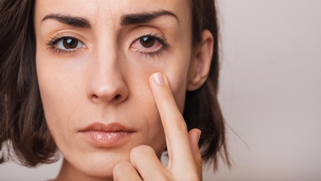 Close-up van rode ogen voor en na behandeling of oogdruppel Vermoeide ogen en contactlenzen Droge ogen depressie ziek virus slaperig