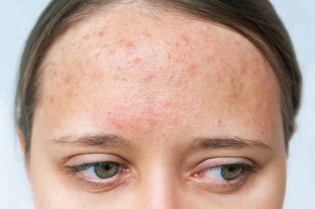 Close up van rode uitslag op een voorhoofd. Bijgesneden opname van het gezicht van een jonge vrouw met acneprobleem. Allergie