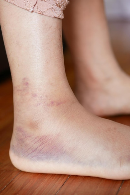 Close up van vrouwen voeten met zwelling