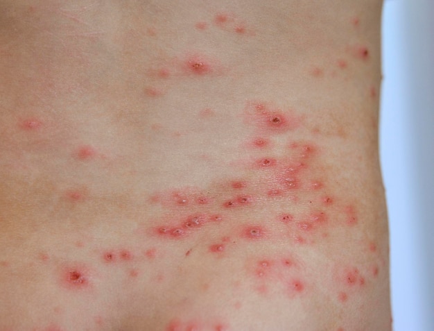 Close-up van waterpokken uitslag Virale infecties ziekte