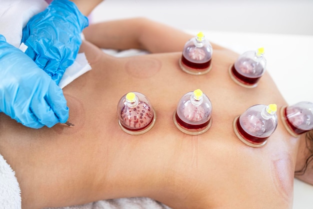 Close up view on cups filled with blood Medical treatment and pain relief