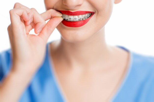 Close up view on woman's smile with tooth braces on the white background